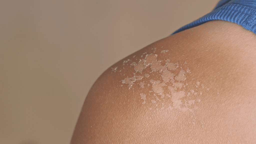 Schulter mit geschälten Hautfetzen nach einem Sonnenbrand